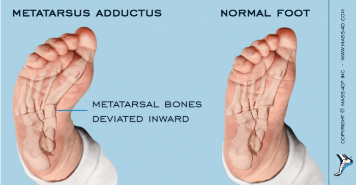 A graphic showing the difference between a metatarsus adductus and a normal foot.